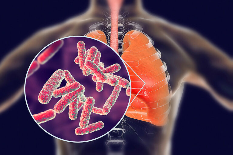 adfasdfasd Hvad er tuberkulose?